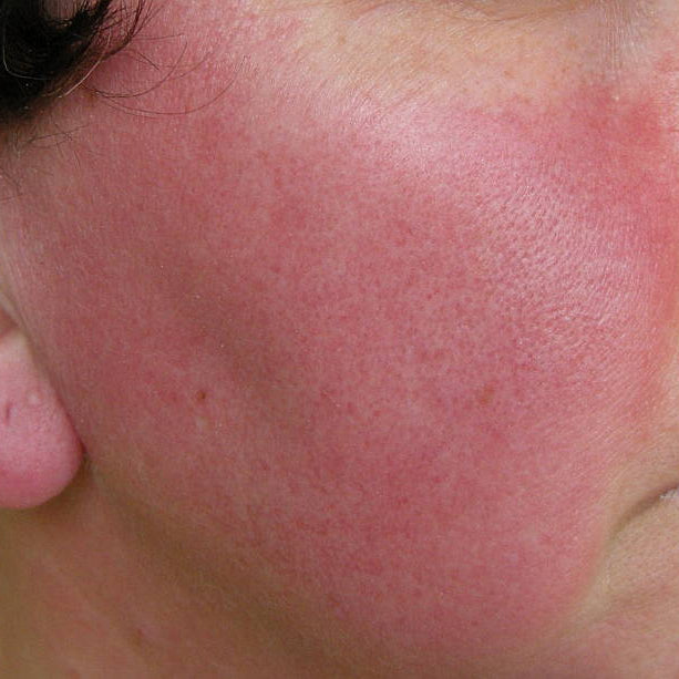 Rosacea Do’s and Don’ts