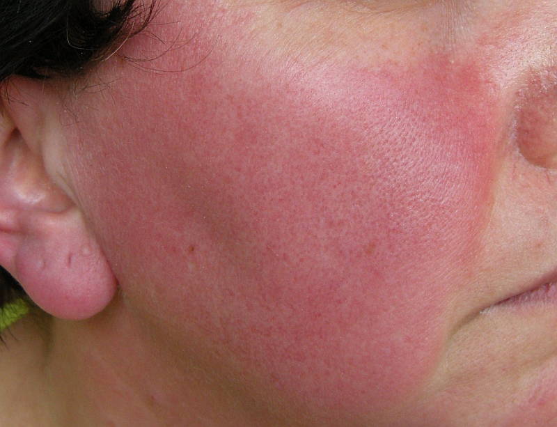 Rosacea Do’s and Don’ts