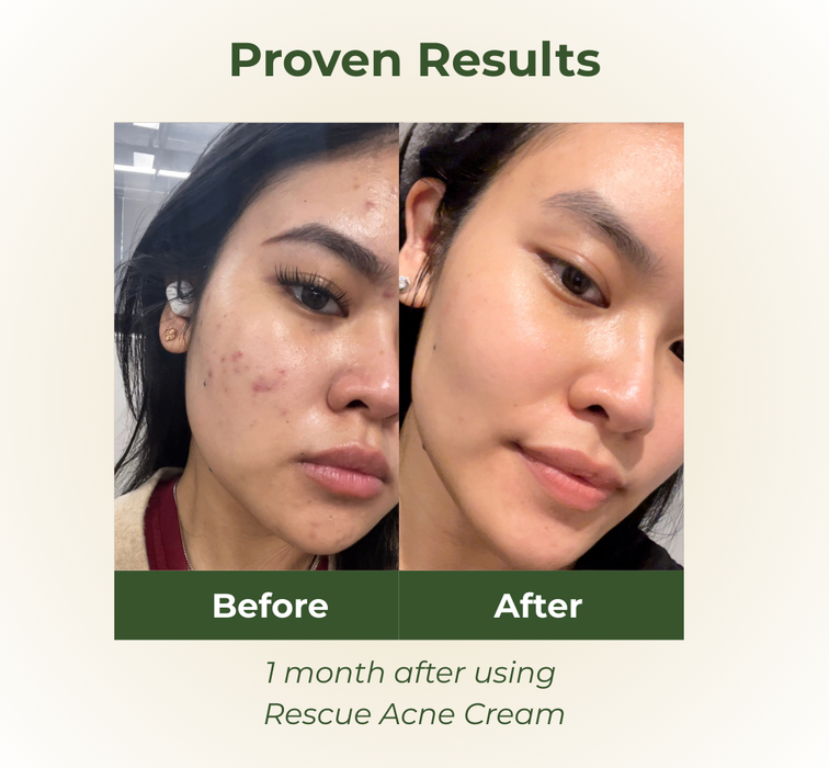 BOTANI RESCUE ACNE CREAM 30g