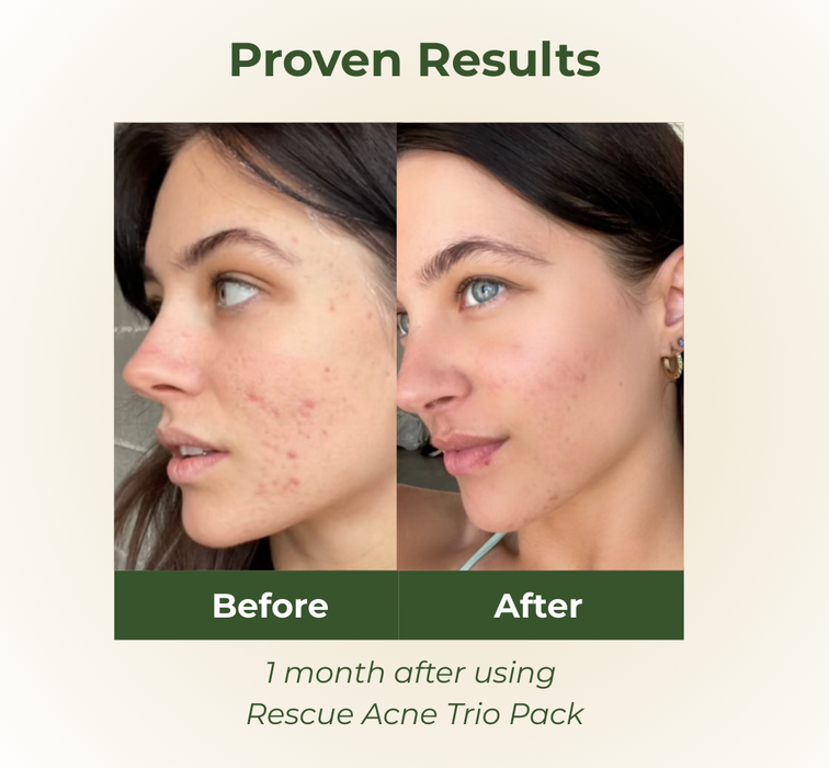 BOTANI RESCUE ACNE TRIO PACK